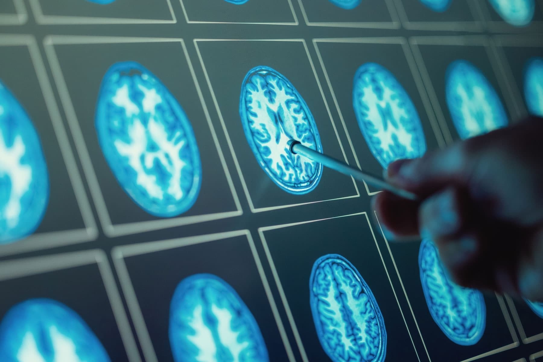 Neurologist Dr. David Perlmutter has spent 30 years challenging how medicine approaches brain disease. His takeaway: Alzheimer's has no single, primary cause, but it is largely preventable through lifestyle choices